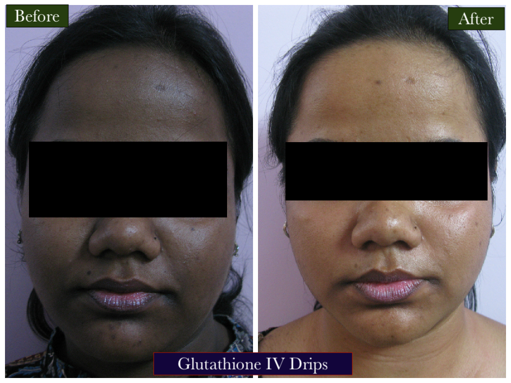 Glutathione IV Treatment